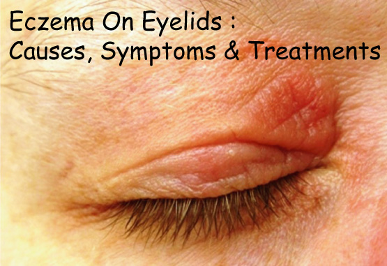 Eczema On Eyelids Causes Symptoms And Treatments Disfreeskin 