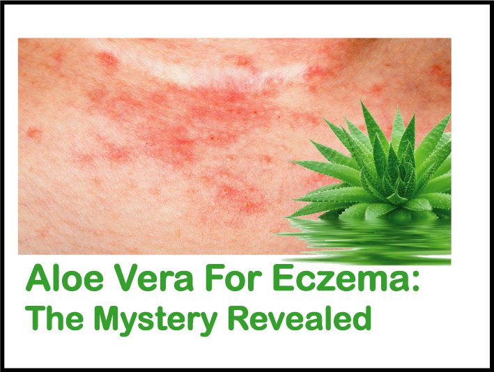 Aloe vera for eczema