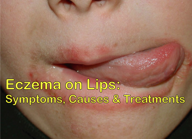 Eczema on lips