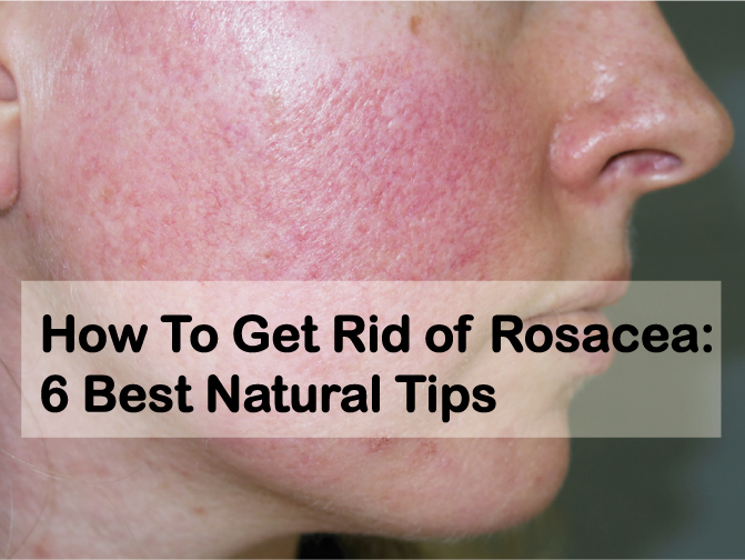 How to get rid of rosacea