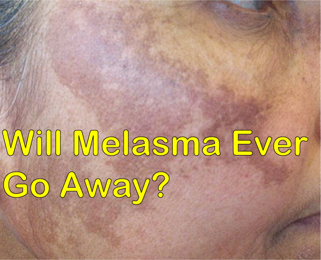 Will Melasma Ever Go Away