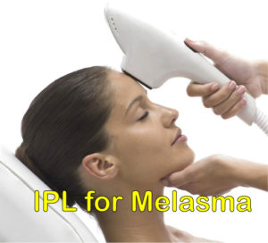 IPL for melasma