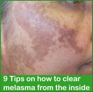 How to clear melasma from the inside