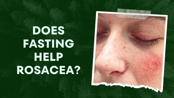 Does Fasting Help Rosacea
