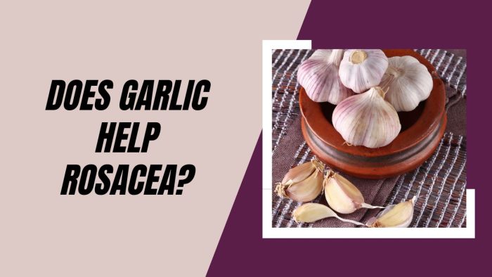 Does Garlic Help Rosacea