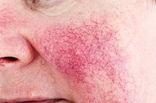 Does Ice Help Rosacea