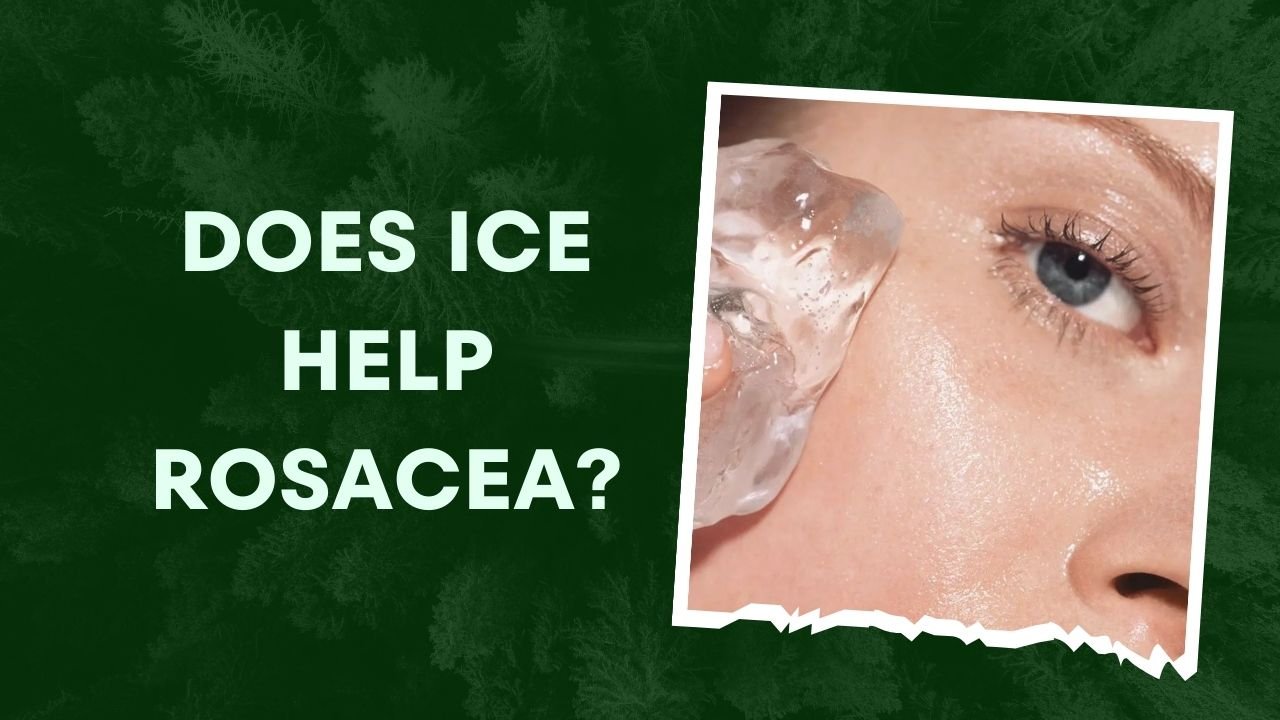 Does Ice Help Rosacea