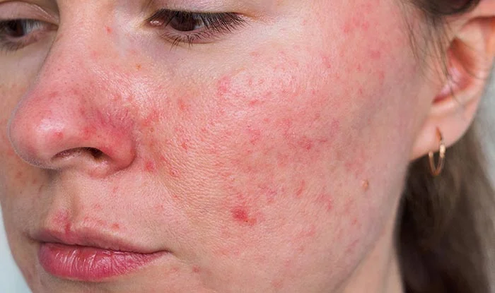 Does Rubbing Alcohol Help Rosacea? 