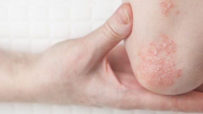 Can Dirty Towel Cause Eczema