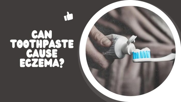 Can Toothpaste Cause Eczema