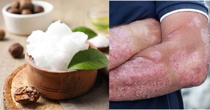 Shea Butter Can Help Psoriasis